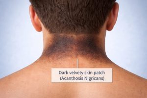 acanthosis nigricans — sign of metabolic dysfunction and insulin resistance in teens