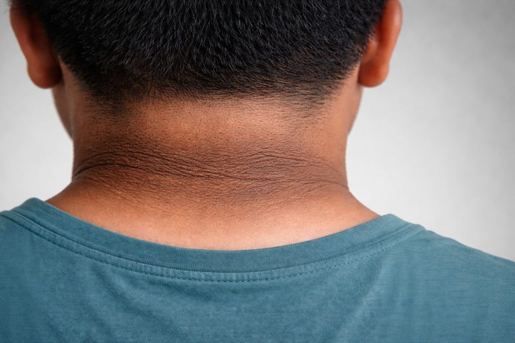 dark neck skin in teenagers showing dark velvety patch on back of teen neck sign of insulin resistance