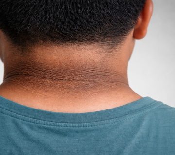 dark neck skin in teenagers showing dark velvety patch on back of teen neck sign of insulin resistance