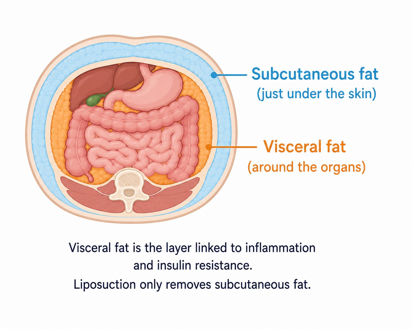 diagram showing difference between visceral fat and subcutaneous fat in belly fat in teenagers and their health effects
